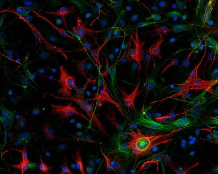  Glioblastoma mesenquimal de ratón con las células madre marcadas en color verde y las células diferenciadas en rojo. - CNIO-EuropaPress 