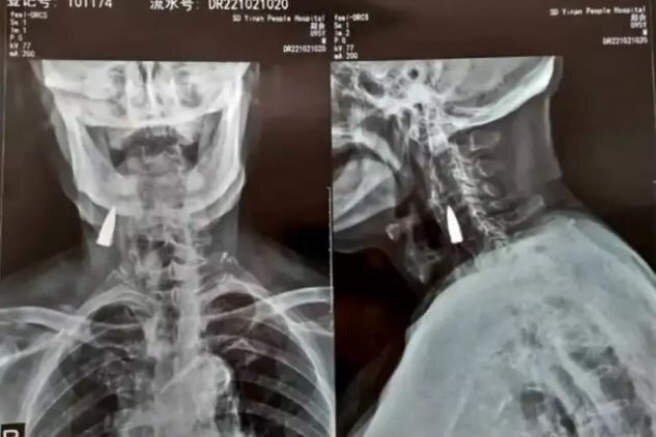  La radiografía del anciano chino de 95 años con la bala en su cuello 