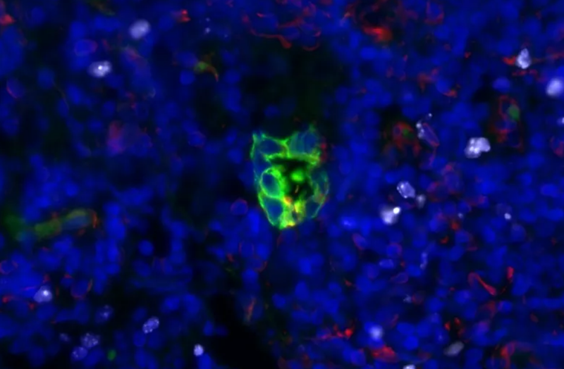  Un grupo quiescente de células tumorales de adenocarcinoma de pulmón de un ganglio linfático de un paciente muestra una baja expresión de STING. Imagen cortesía del laboratorio Massagué. 