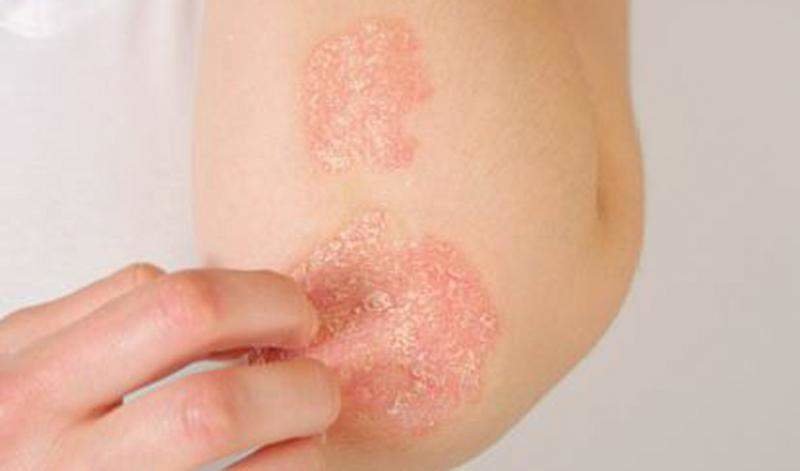  Dermatólogos andaluces publican un manual digital de casos clínicos de psoriasis 