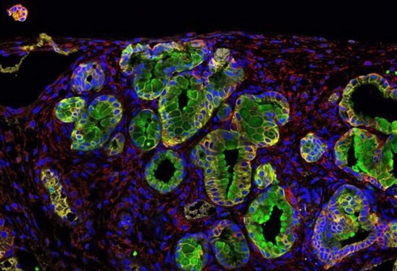  Inmunofluorescencia de un tumor de páncreas; la proteína PGLYRP1 en verde. - BRUNO SAINZ (IIBM-CSIC-UAM) 