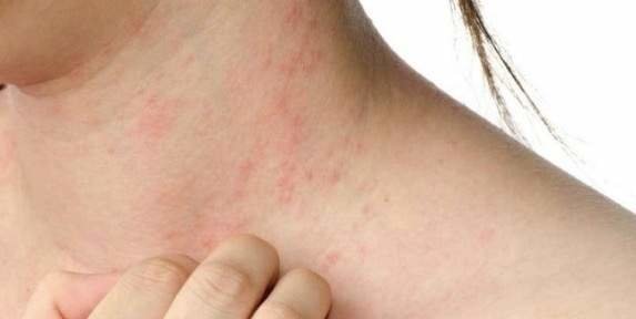  Dermatitis Atópica 